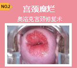 奥洛克宫颈修复术——治疗宫颈糜烂达到国际水